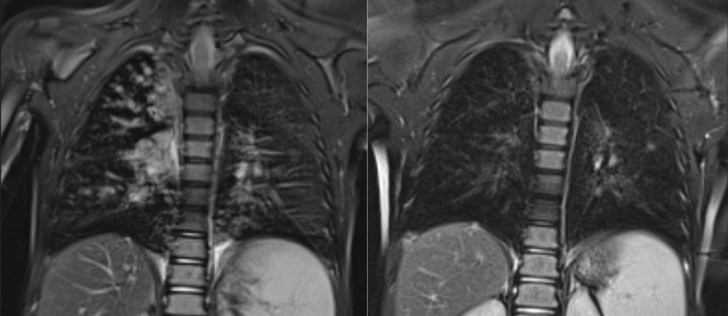 Two MRI images of a child's torso side by side (in shades of gray). The spine, some internal organs and the lungs are visible. Mucus deposits, widening of the bronchi, and thickening of the bronchial walls are clearly visible in the lungs (left). Six months after receiving triple combination therapy, these changes are nearly completely reversed (right). © Charité | Felix Döllinger